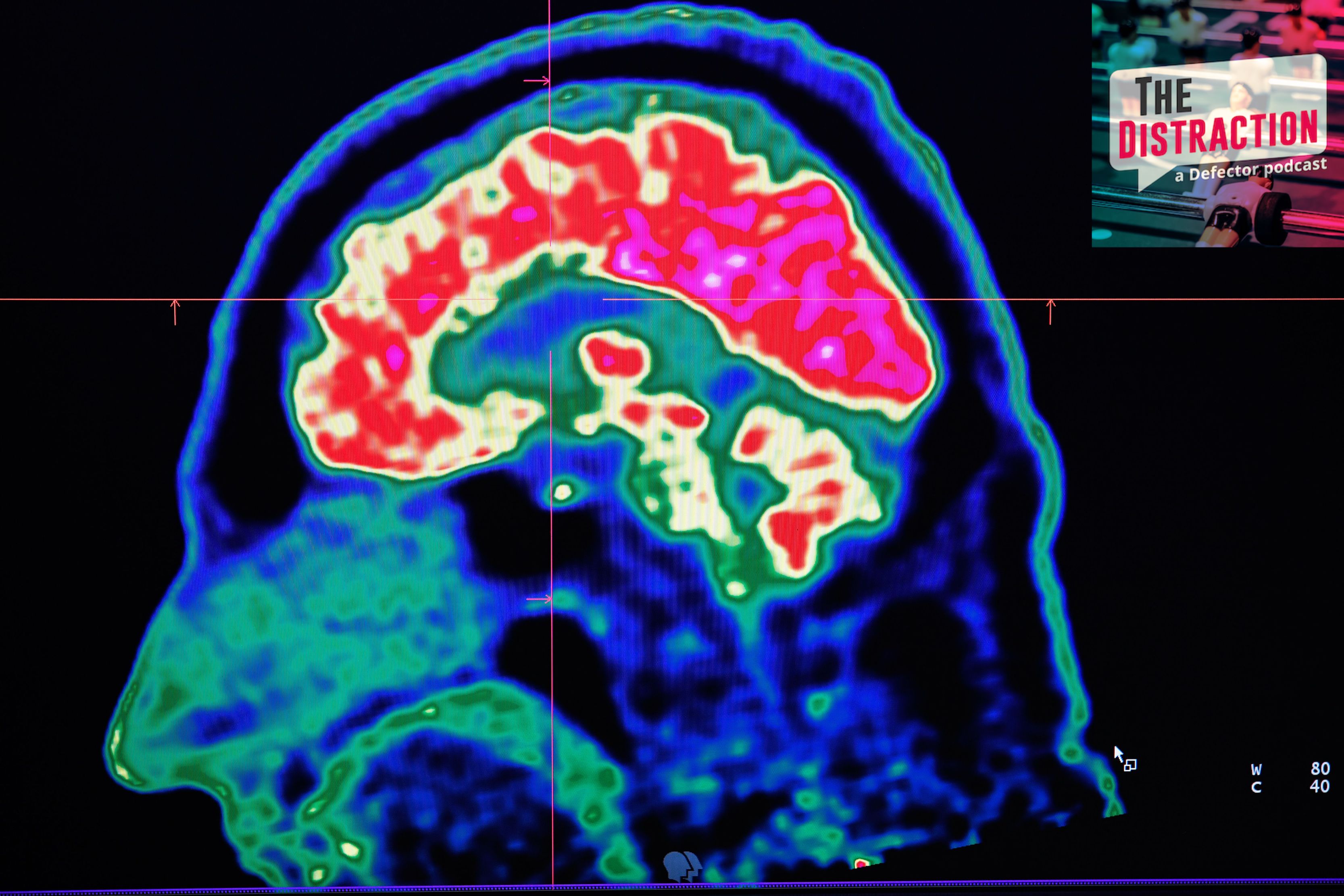A picture of a human brain taken by a positron emission tomography scanner.