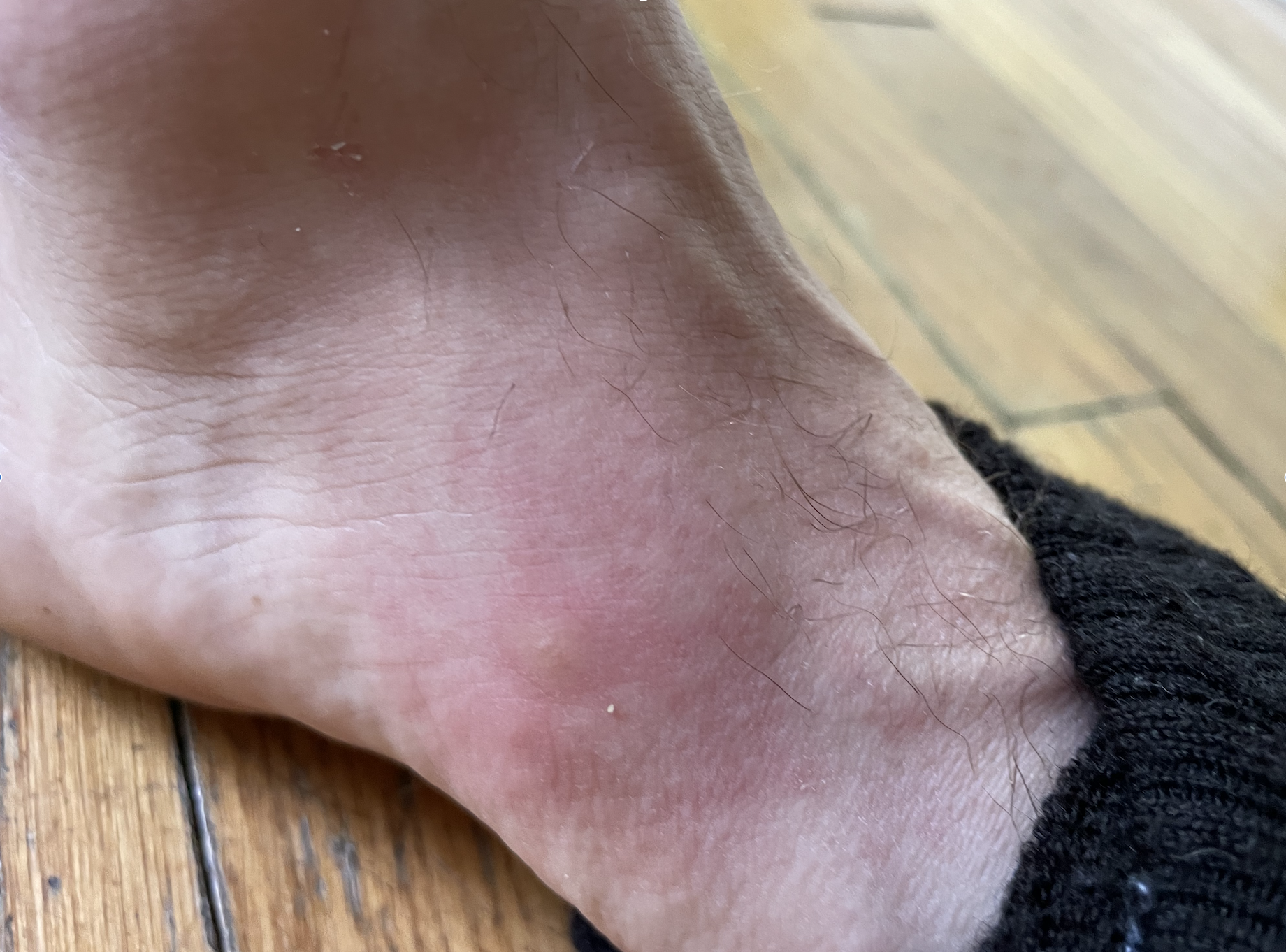 Mosquito bite on a foot
