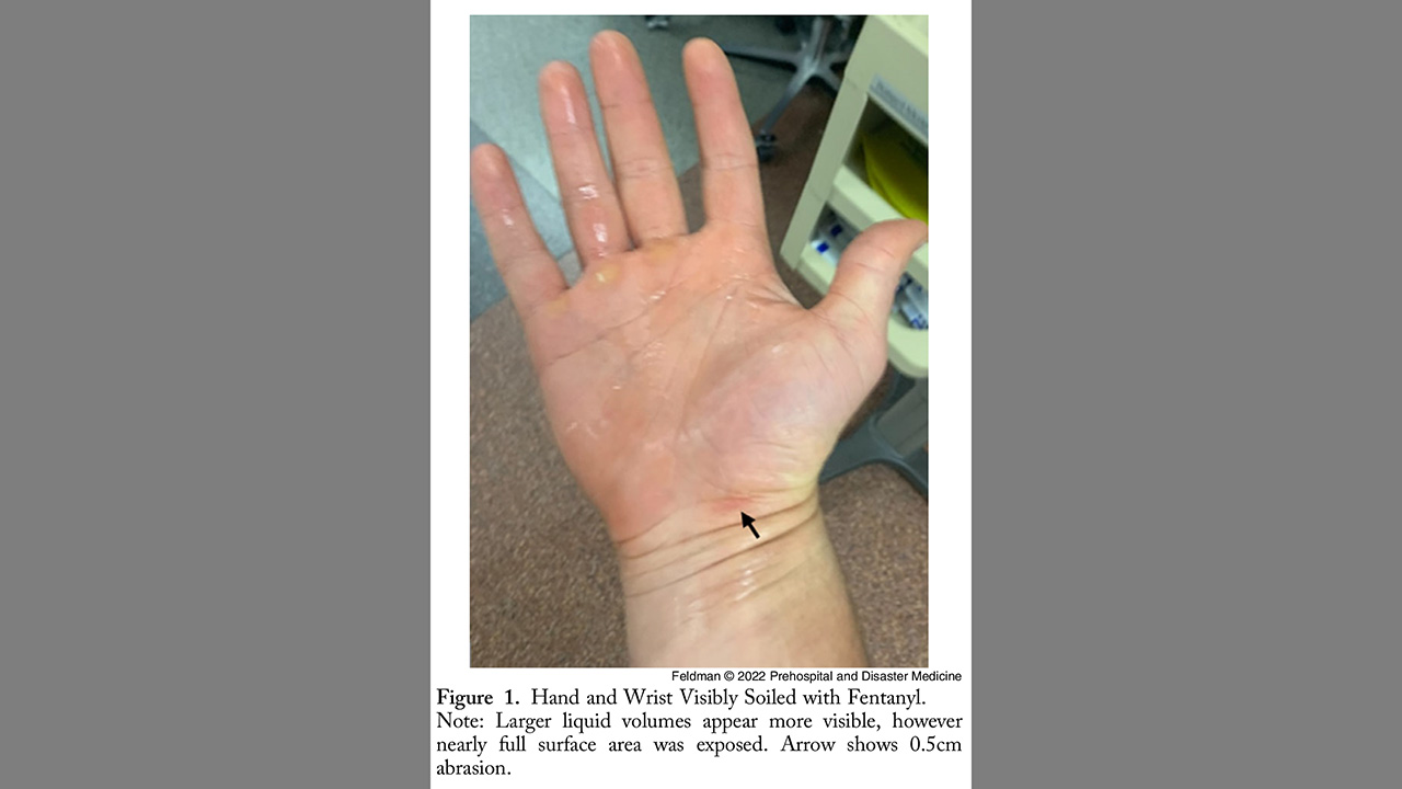 A hand covered in fentanyl. With a caption: 'Figure 1. Hand and Wrist Visibly Soiled with Fentanyl. Note: Larger liquid volumes appear more visible, however nearly full surface area was exposed. Arrow shows 0.5cm abrasion.'