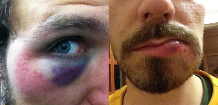 Two gruesome softball injuries suffered by the author: A big black swollen eye, and a really fat lip. Split photo.