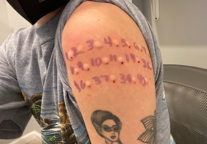 A horrible shot of my 17 blebs in my arm from 17 allergy shots